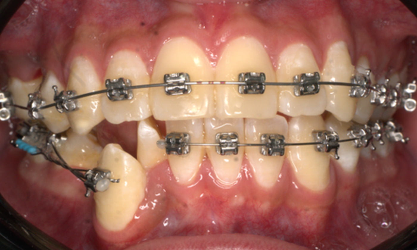 ANTES